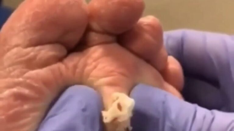 puntos negros planta del pie