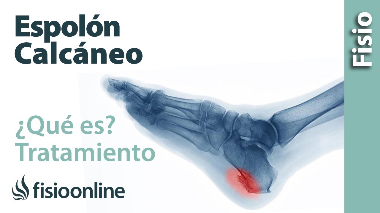qué es espolones en los pies