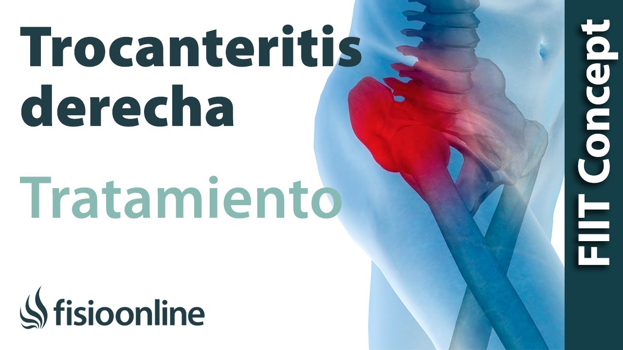 que es la trocanteritis derecha