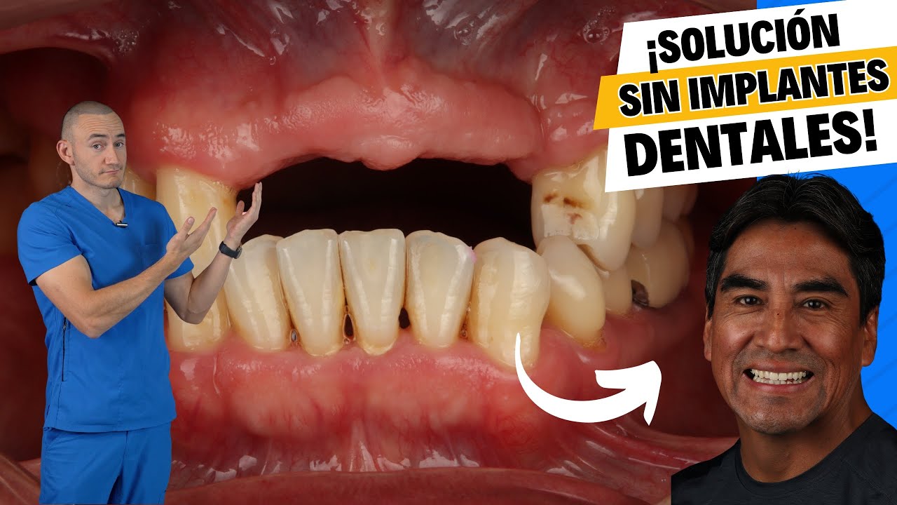 quitar dientes y poner dentadura