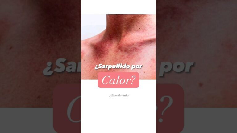 sarpullido por calor como se quita