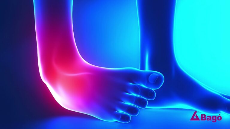 se puede andar con un esguince de tobillo