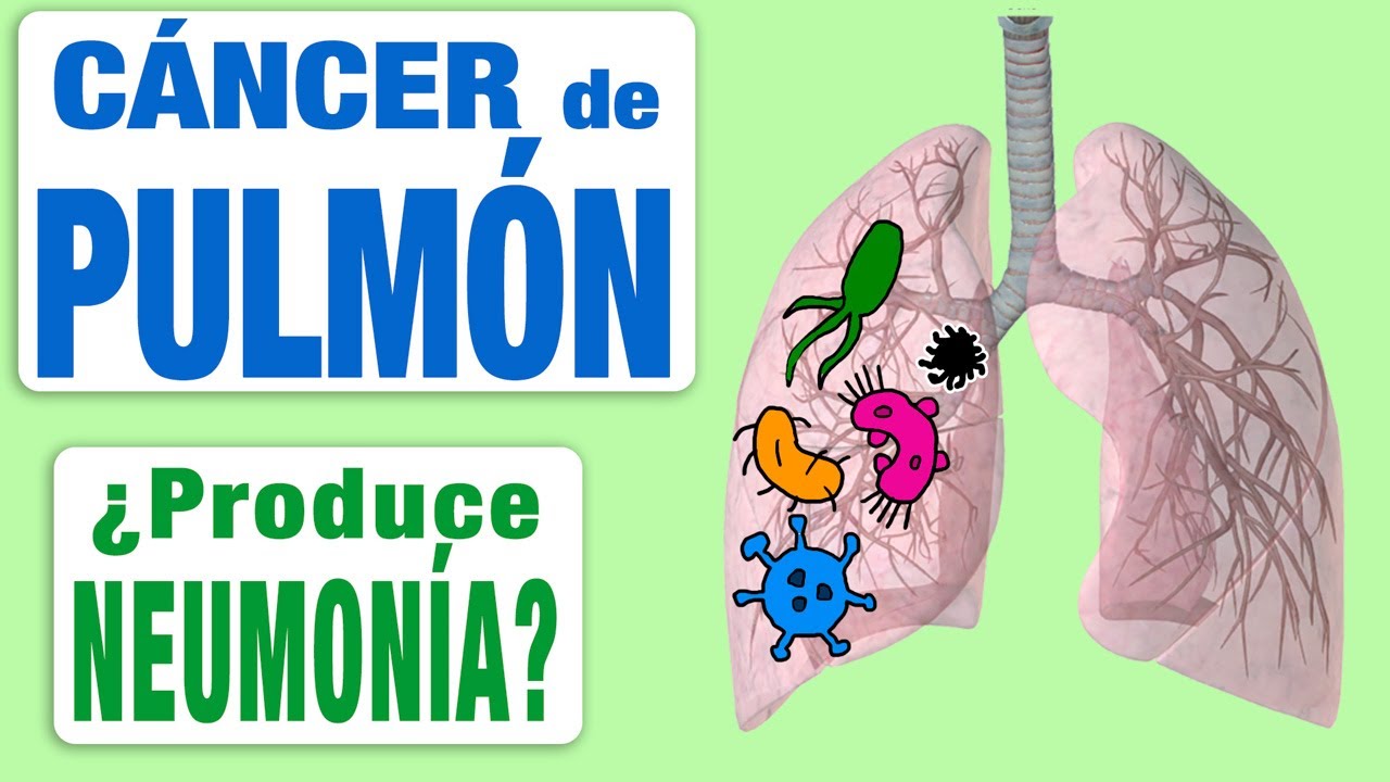 se puede confundir neumonia con cancer de pulmon