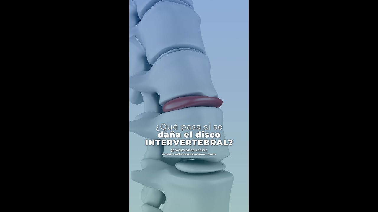se puede vivir sin disco intervertebral