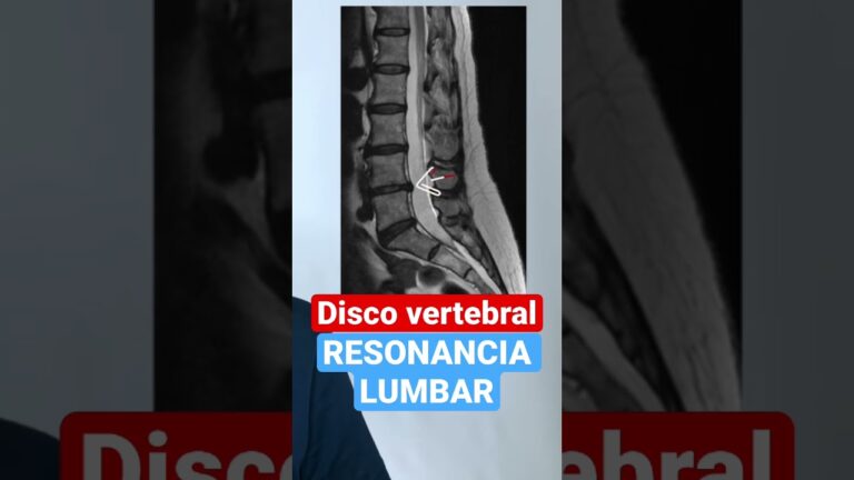se ven las hernias discales en radiografía