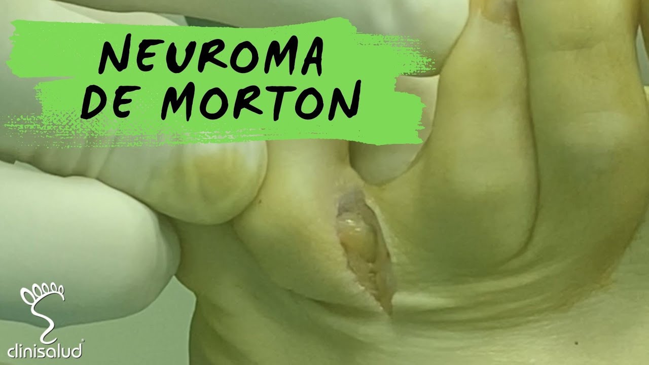 secuelas operación neuroma de morton