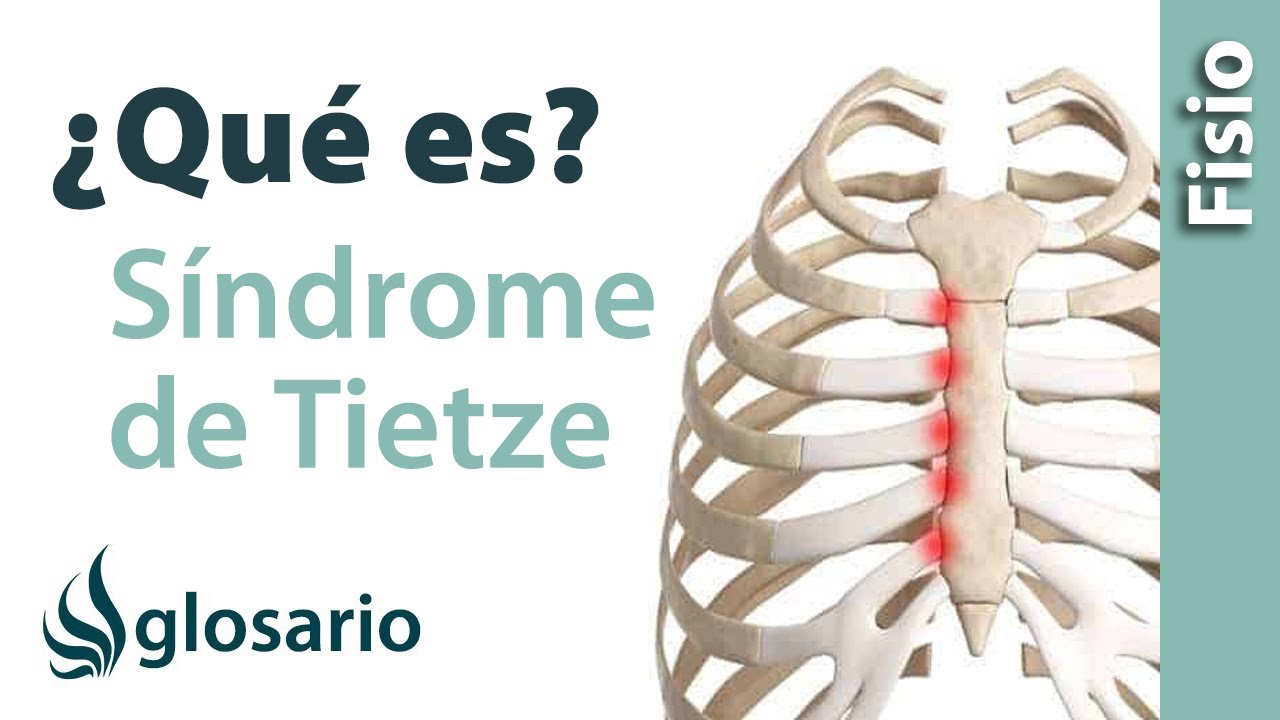 síndrome de tietze es peligroso