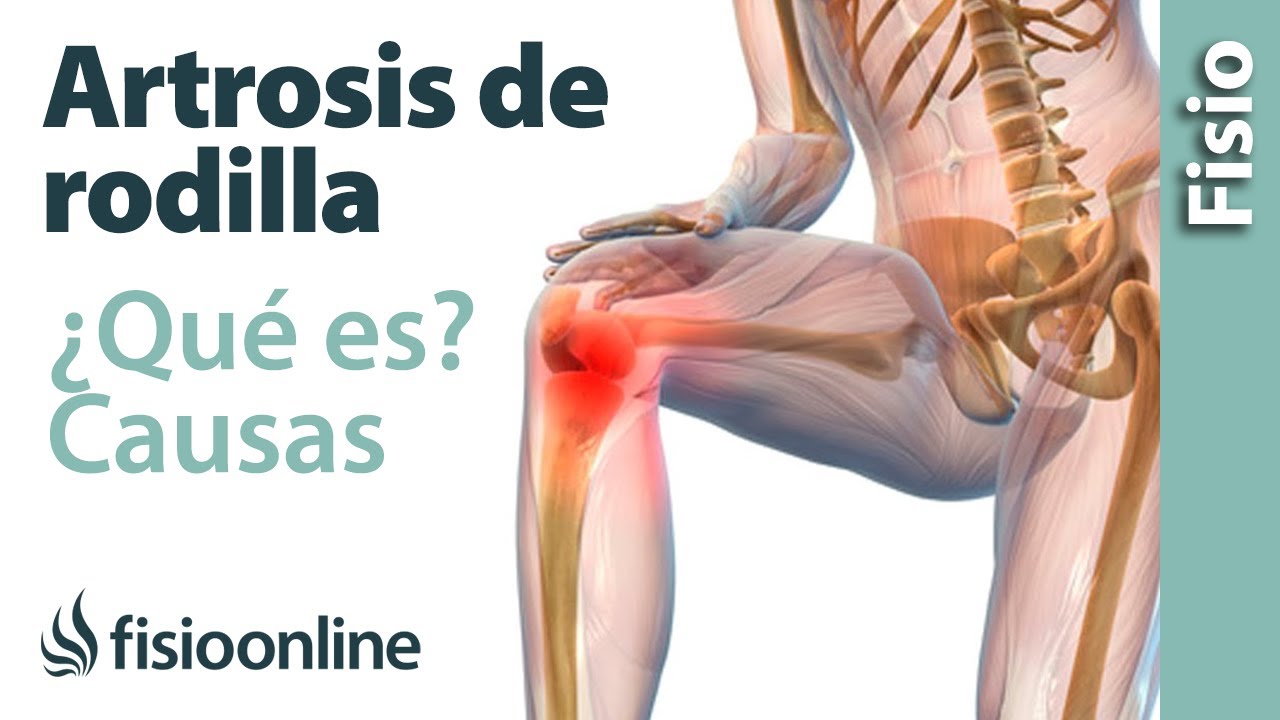 sintoma de artrosis de rodilla