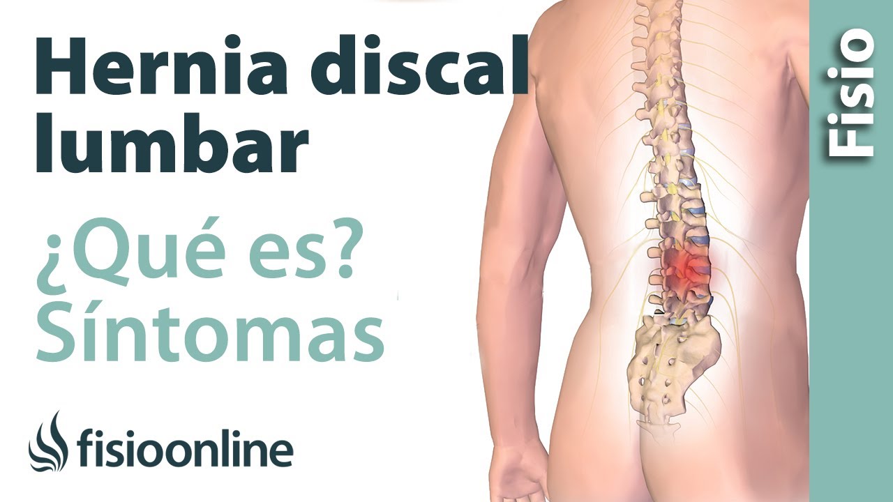 sintomas de una hernia discal