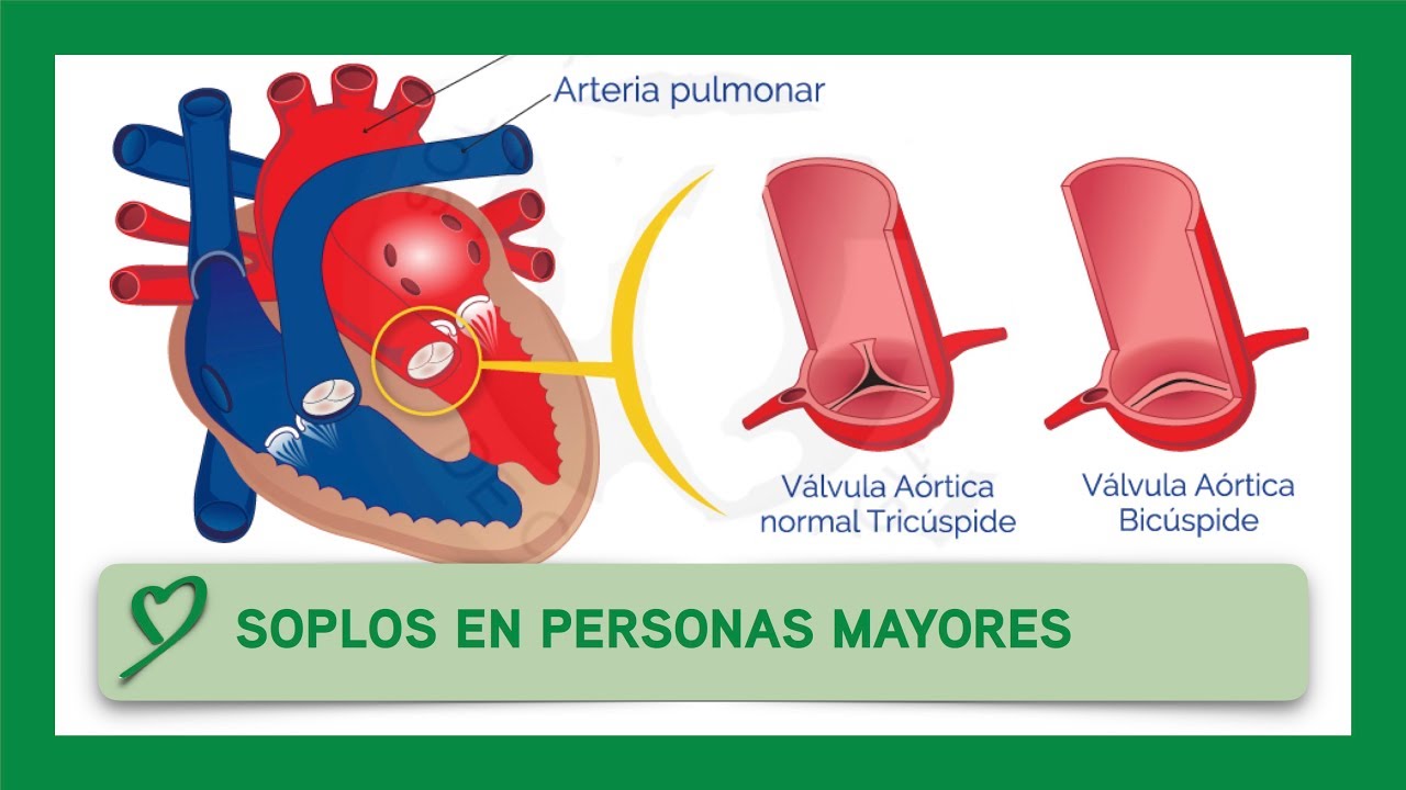 soplo en el corazon personas mayores