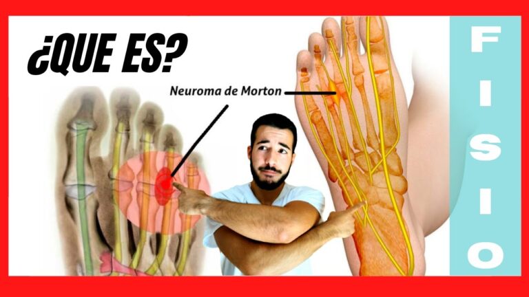 tiempo de baja por neuroma de morton