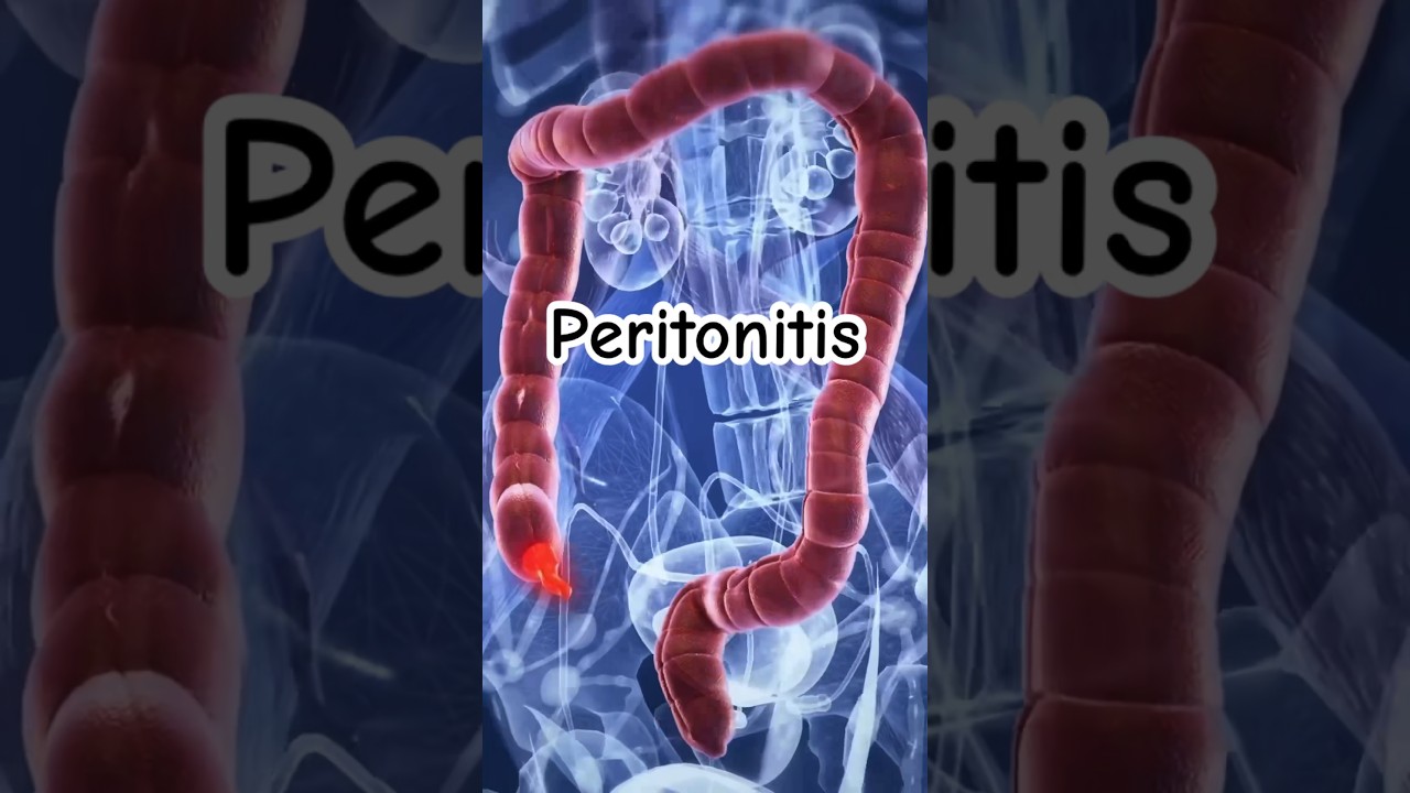 tiempo de baja por peritonitis