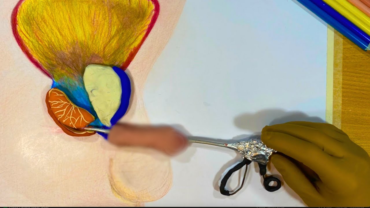 tipo de operaciones de prostata