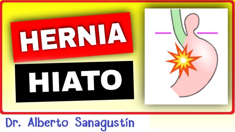 tipos de hernia de hiato