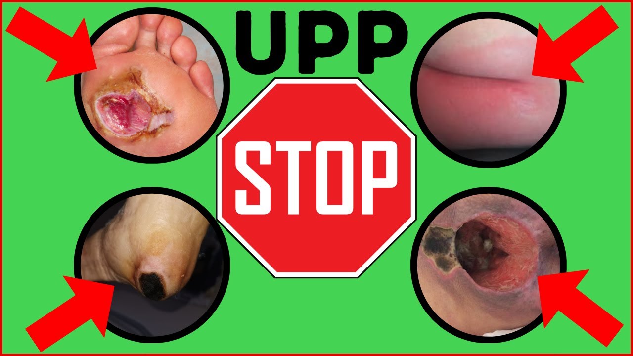 tipos de ulcera por presion