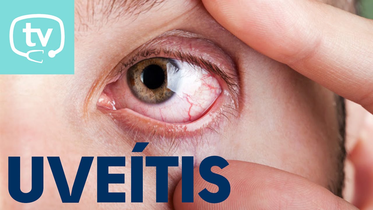 tipos de venas en los ojos