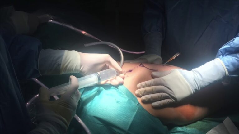 trocanteritis y cadera en resorte