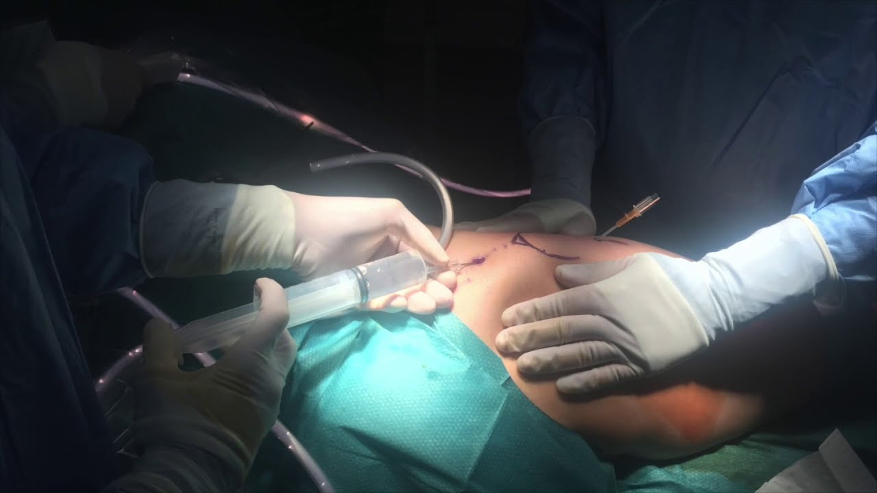 trocanteritis y cadera en resorte