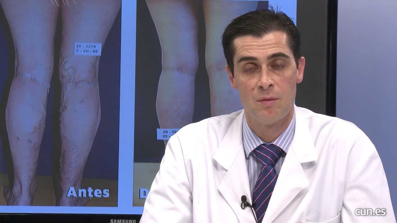 úlceras en las piernas en ancianos