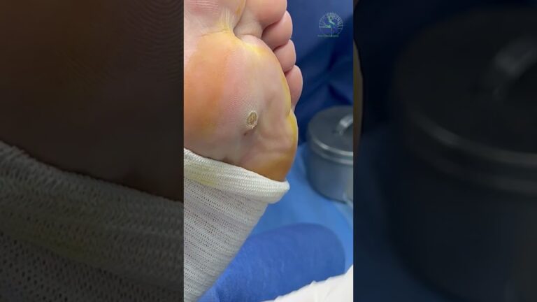 verruga en el dedo del pie