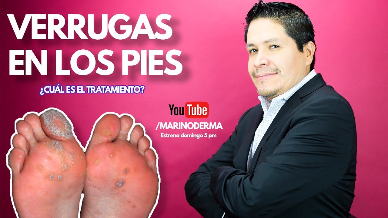 verruga en la planta del pie
