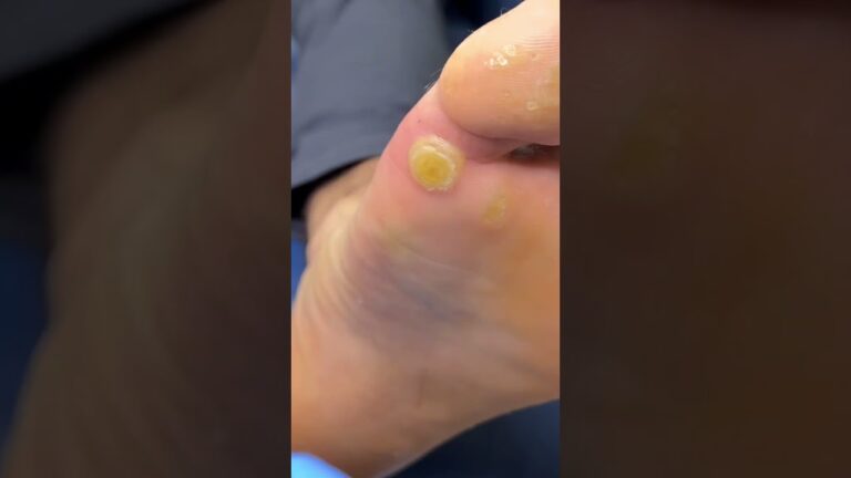 virus del papiloma humano en los pies